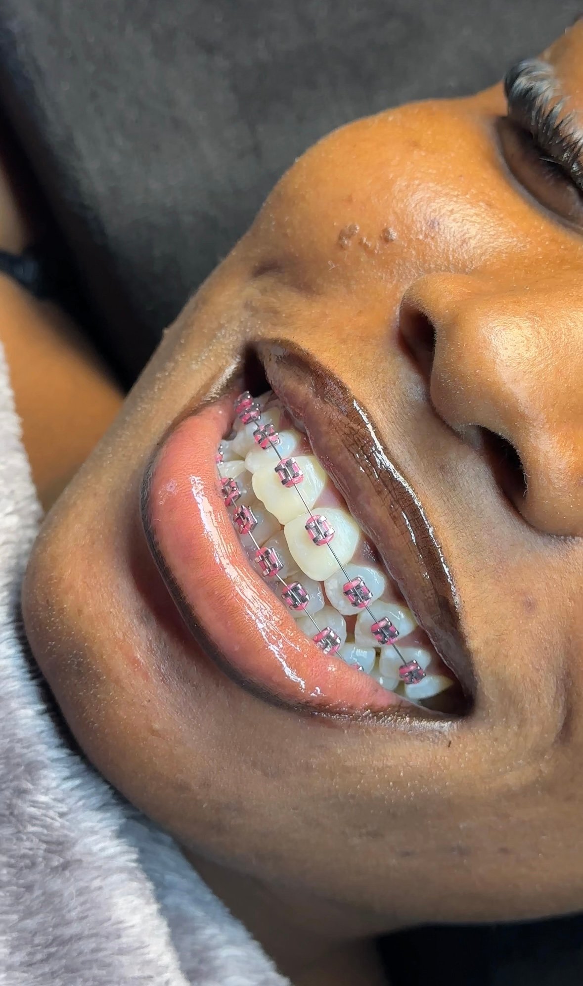 Fashion braces - Oring