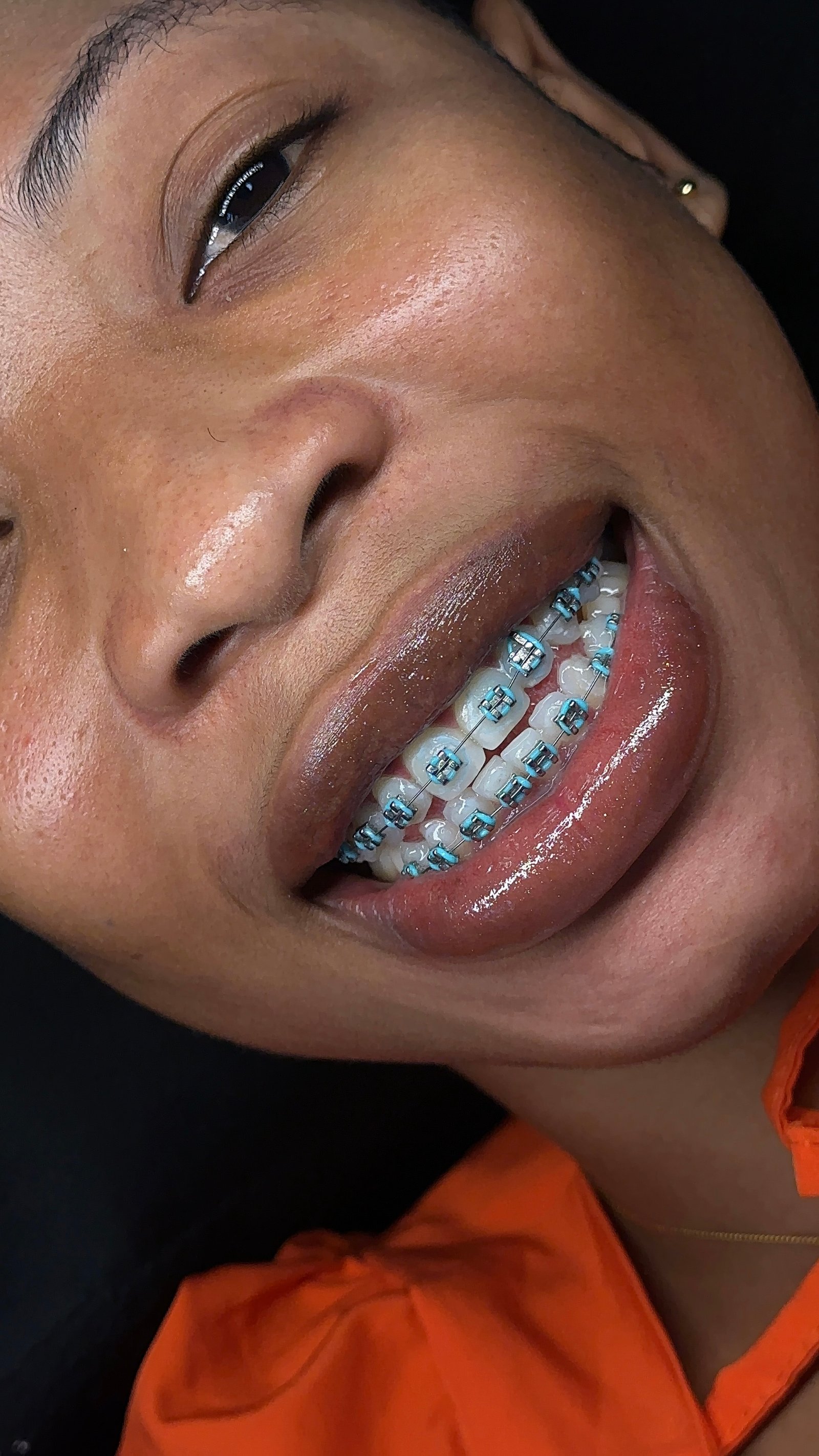 Fashion braces - Oring
