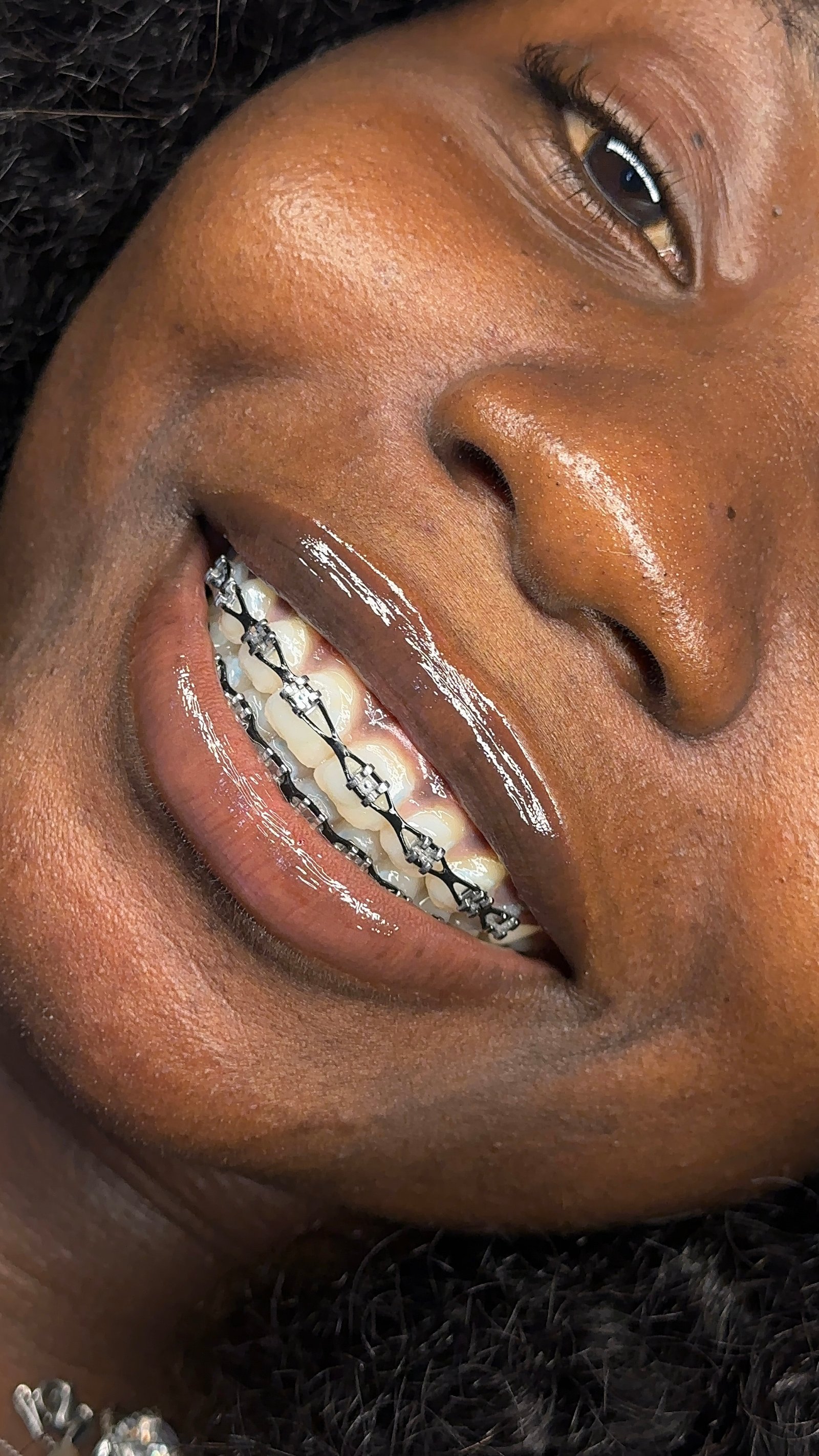 Fashion braces - Powerchain